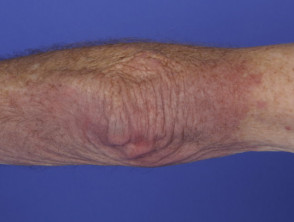 Dermatomyositis des Arms 
