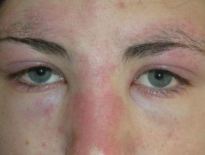 Augenlider Dermatomyositis 01