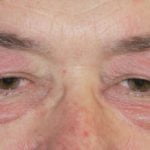 dermatomyositis-eyelids-02__protectwyjqcm90zwn0il0_focusfillwzi5ncwymjisingilduyxq-3988807-7301722-jpg-4716641
