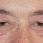 dermatomyositis-eyelids-02__protectwyjqcm90zwn0il0_focusfillwzi5ncwymjisingilduyxq-3988807-7301722-jpg-4716641
