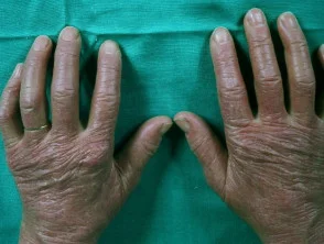 Dermatomiosite della mano 