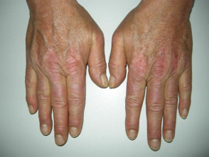 Dermatomiositis de la mano 
