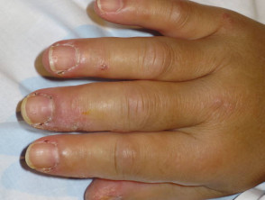 Dermatomiositis de la mano 
