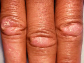 Dermatomiosite della mano 