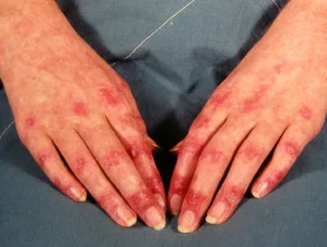 Dermatomiosite della mano 