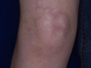 Dermatomiositis de la pierna 