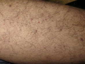 Dermatomiositis de la pierna 