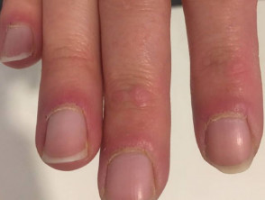 Dermatomiosite delle pieghe delle unghie