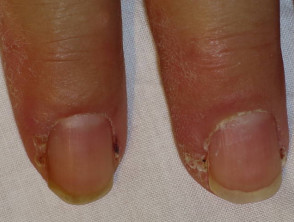 Dermatomiositis del pliegue ungueal