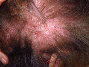 Dermatomiositis del cuero cabelludo