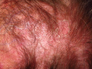 Dermatomyositis der Kopfhaut