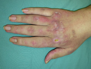 Dermatomiositis - pápulas de Gottron