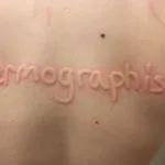 Dermographism-300__protectwyjqcm90zwn0il0_focusfillwzi5ncwymjisingildfd-2149106-5054643-jpg-1187624