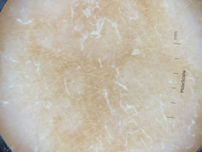 Dermatoscopia de pitiriasis versicolor