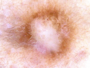 Dermatoscopia.  Área blanca central prominente: dermatofibroma