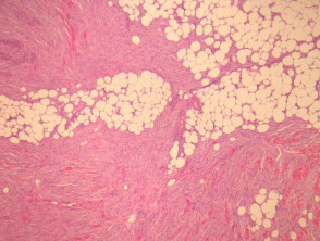 Pathologie von Dermatofibrosarkom protuberans