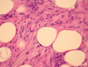 Patología del dermatofibrosarcoma protuberans