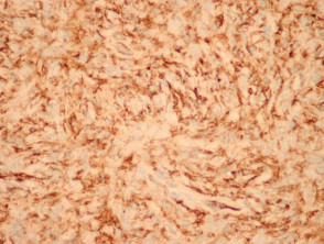 Patología del dermatofibrosarcoma protuberans: tinción CD34