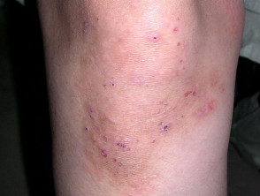 Dermatitis herpetiforme