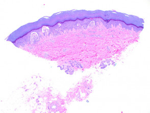 Patología de la dermatitis herpetiforme