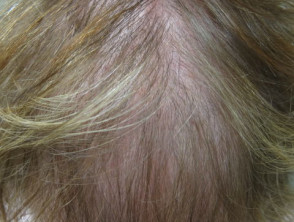 Alopecia de patrón femenino