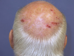 Alopecia de patrón masculino