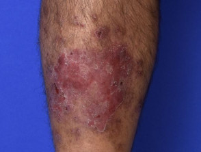 Dermatitis numular