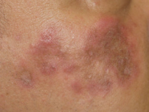 Lupus eritematoso discoide crónico 