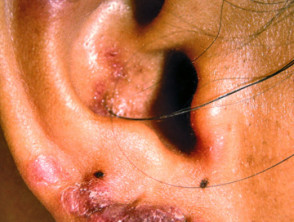 Lupus eritematoso discoide crónico