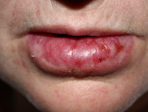 Lupus eritematoso discoide crónico en labios