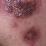 discoid-lupus-face__protectwyjqcm90zwn0il0_focusfillwzi5ncwymjisinkildewov0-4963240-3695997-jpg-8946503