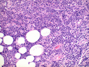Patología del linfoma cutáneo primario difuso de células B grandes