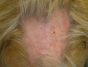 Lupus eritematoso discoide del cuero cabelludo