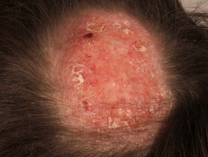 Lupus eritematoso discoide del cuero cabelludo