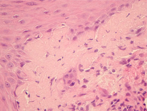 Patología del lupus eritematoso discoide