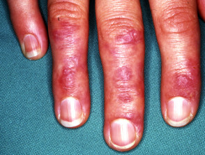 Dermatomyositis der Hand 