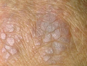 Dermatomiosite