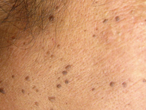 Dermatosis papulosa negra