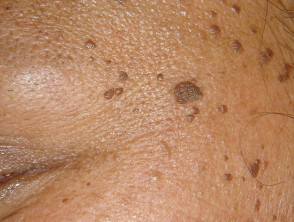 Dermatosis papulosa negra