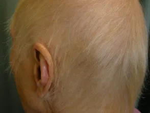 medicijn alopecia