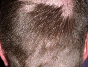 Alopecia por drogas