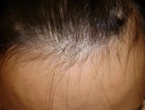 medicijn alopecia