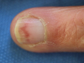 Distrofia ungueal inducida por hidroxiurea