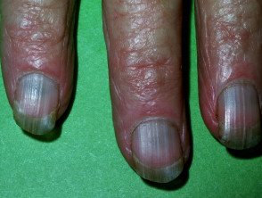 Pigmentación de uñas inducida por minociclina