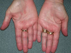 Allergische contactdermatitis van de handen.