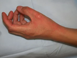 Allergische contactdermatitis van de handen.