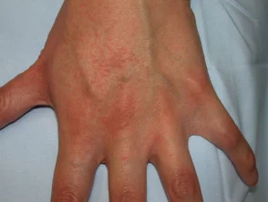 Allergische contactdermatitis van de handen.