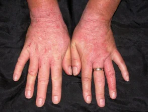 Allergische contactdermatitis van de handen.