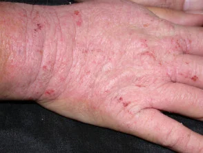 Allergische contactdermatitis van de handen.