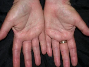 Allergische contactdermatitis van de handen.